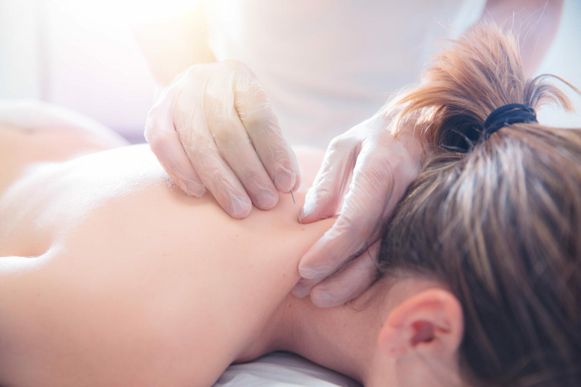 Physiotherapist doing acupuncture on a young woman on her back