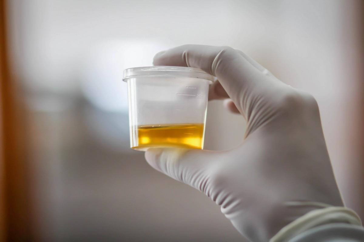 Gloved hand holding a sample of urine.