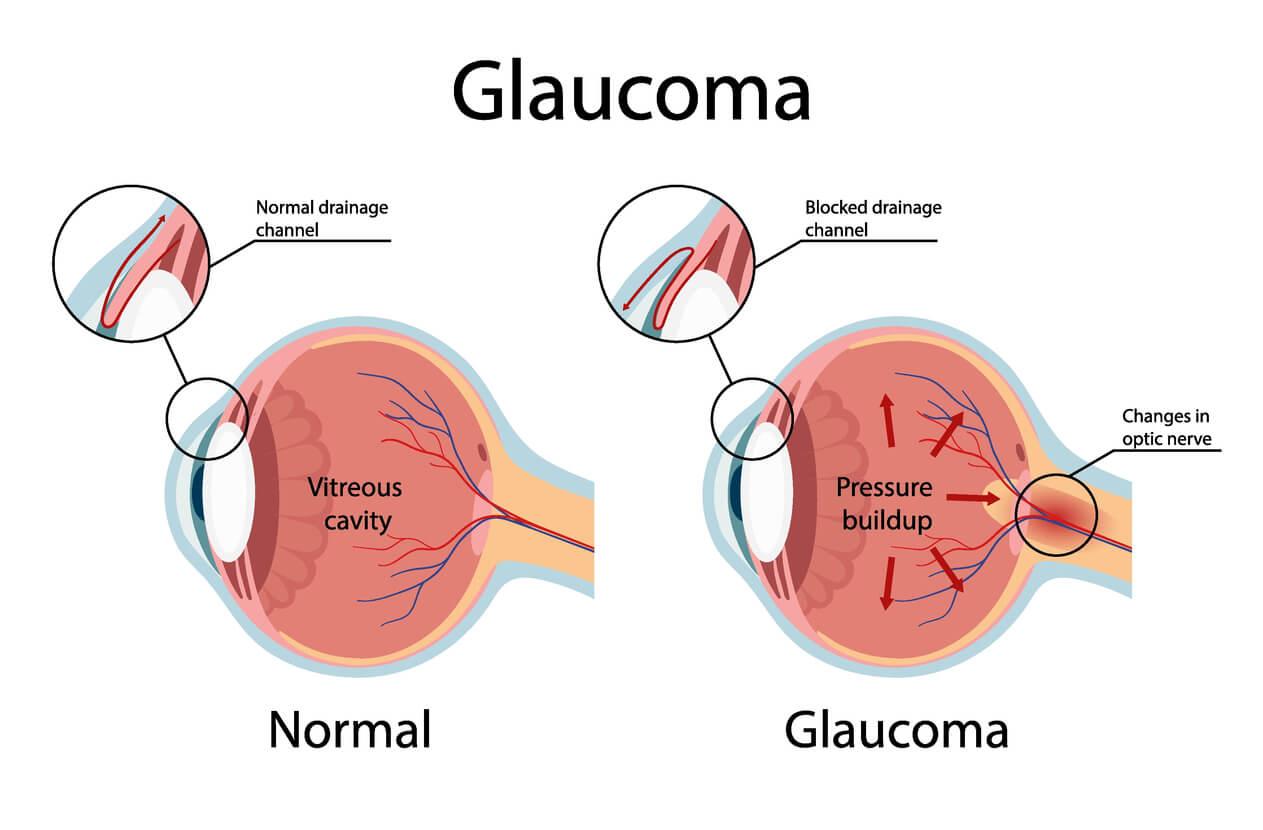 Illustration showing open-angle glaucoma.