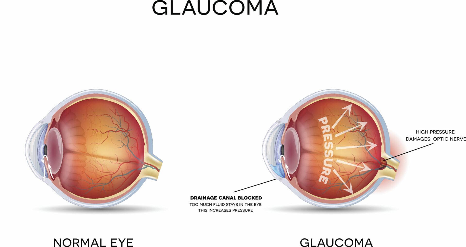 Glaucoma stock illustration
