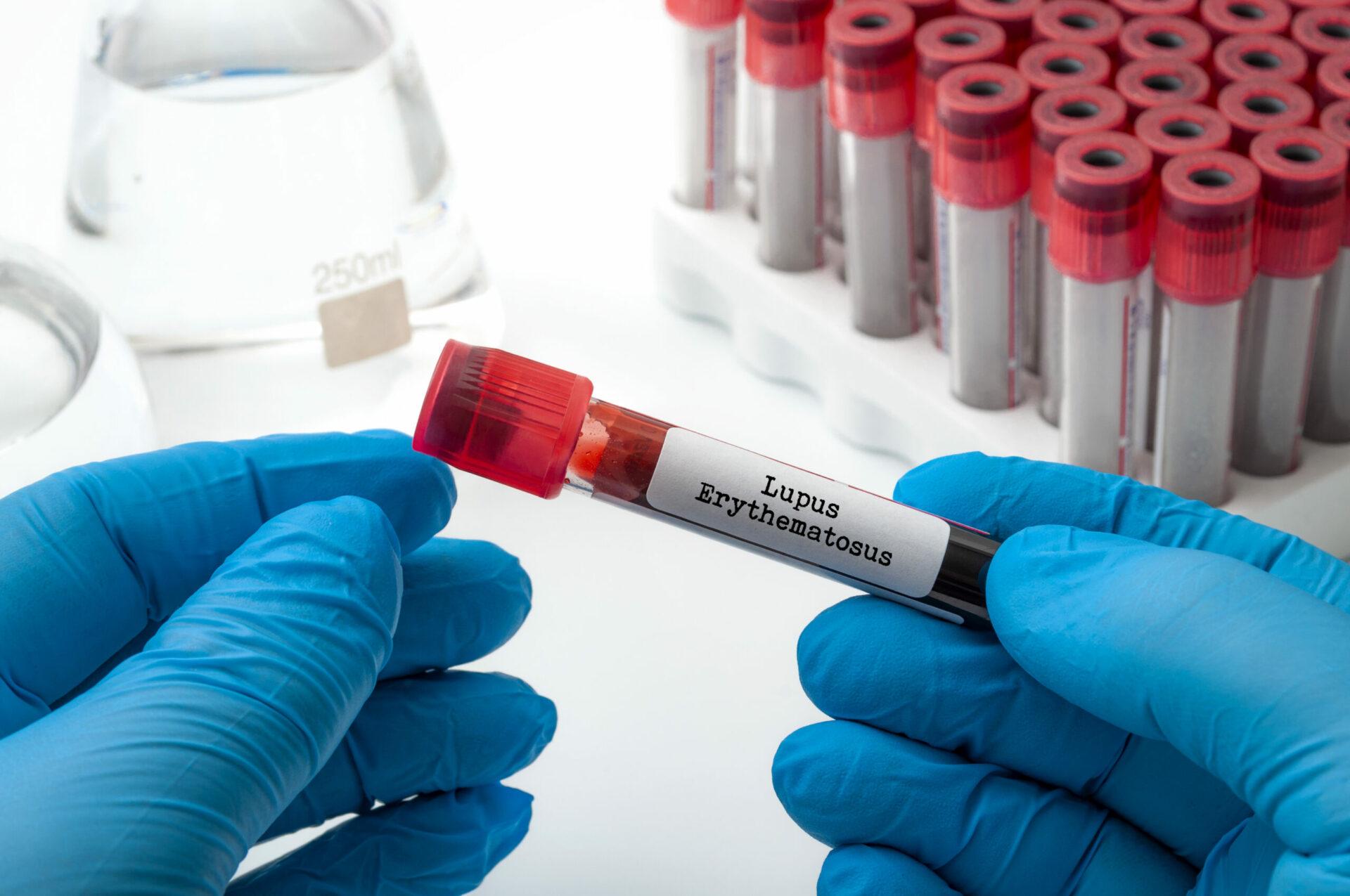 Doctor performing blood test on a medical sample while wearing blue latex protection gloves in lab and holding glass tube with the text lupus erythematosus