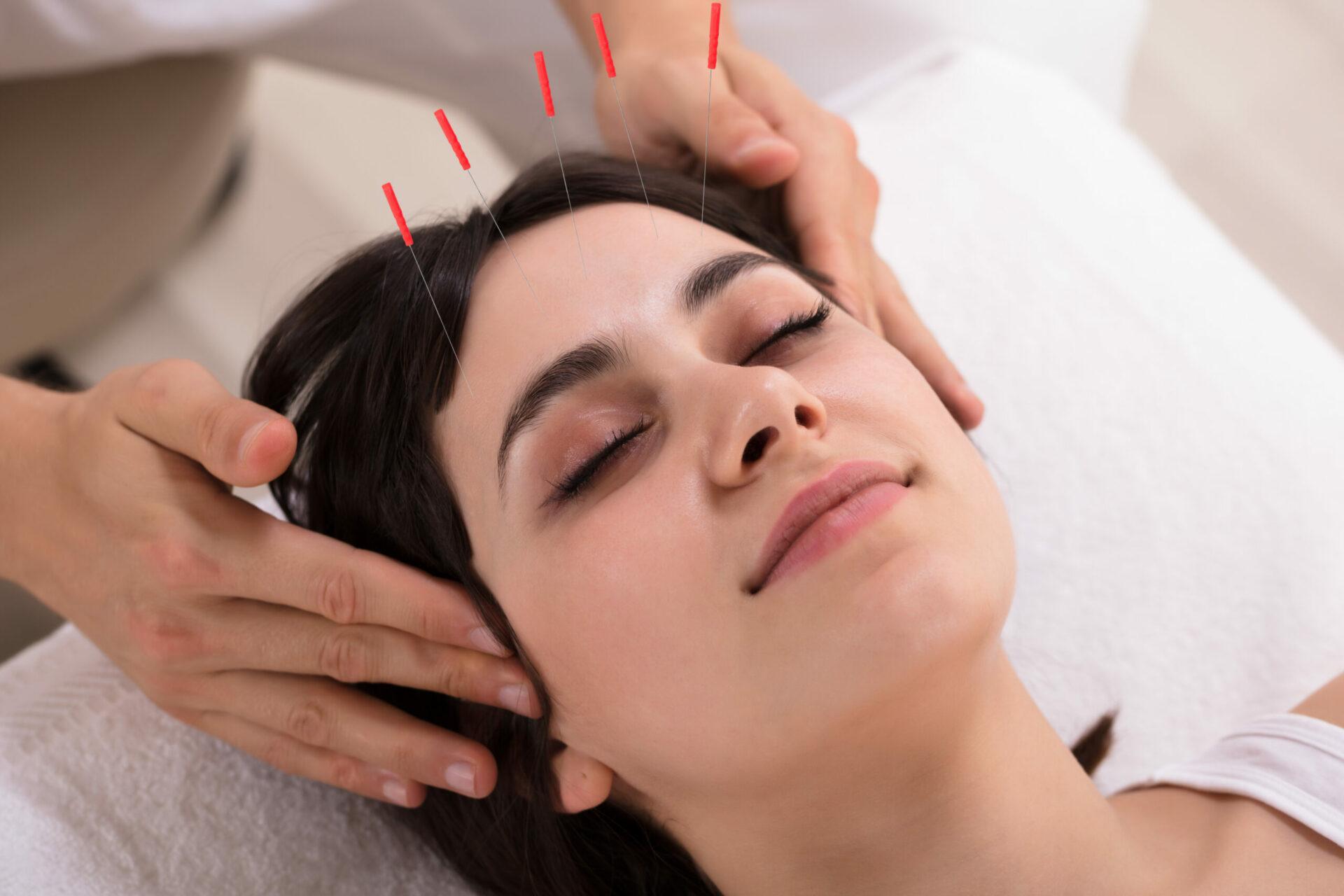 Woman receiving acupuncture on forehead