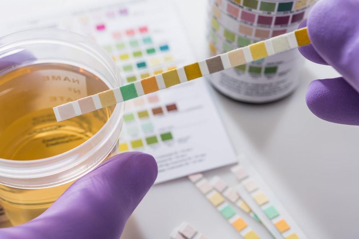 A urine specimen subjected to a colour-based litmus test.