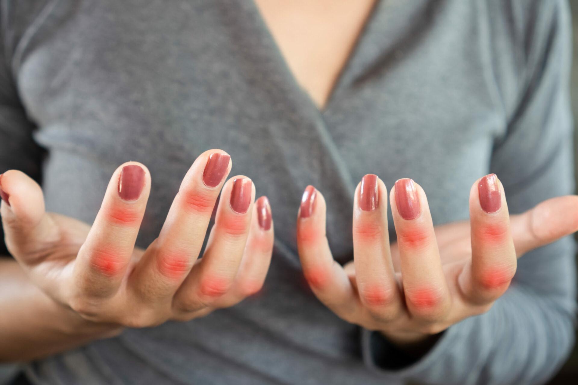 Closeup woman suffering from hand and finger pain caused by lupus