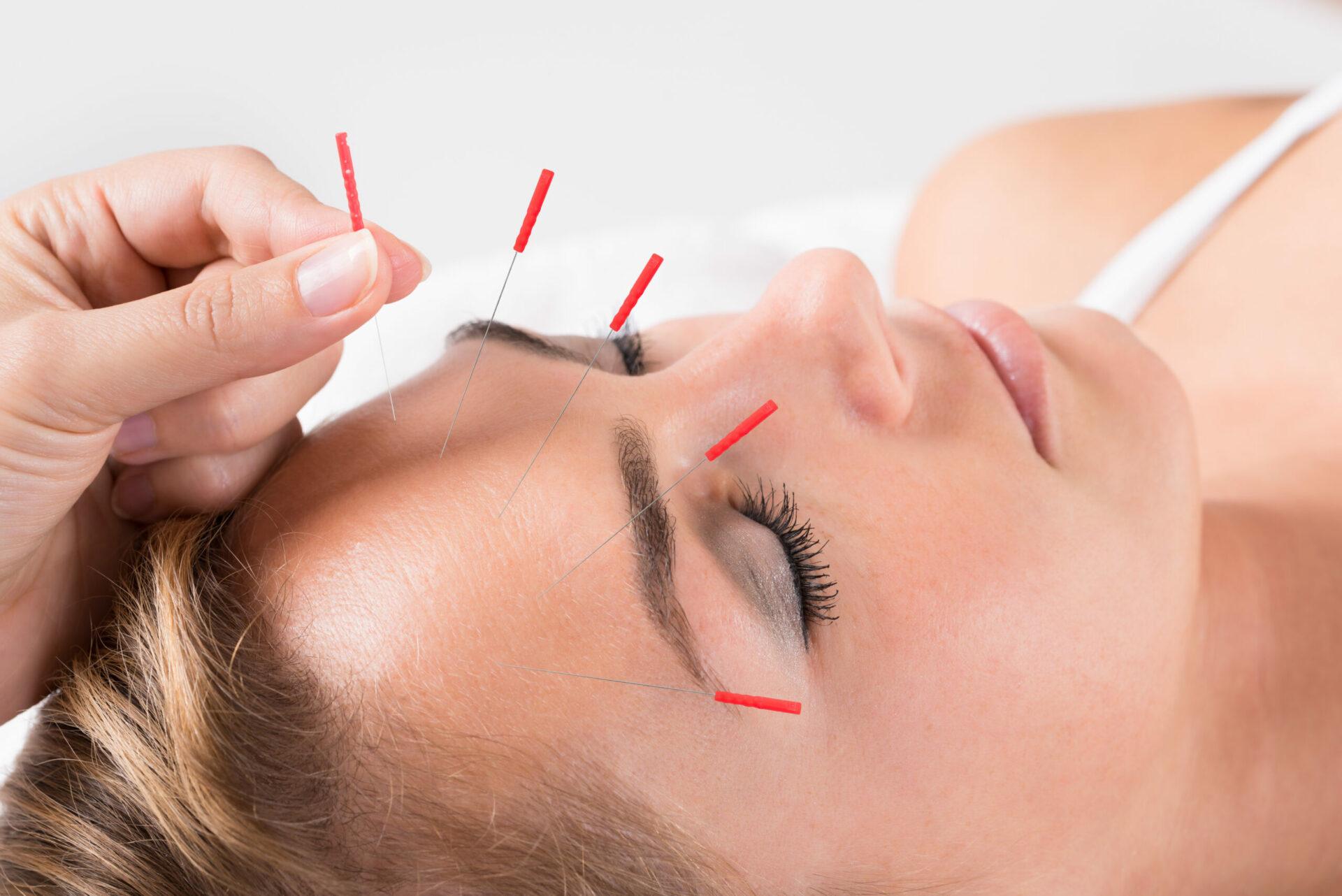 Hand performing acupuncture on woman’s face